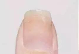 指甲出现哪些症状是有问题的,指甲上有皱纹有什么信号求救