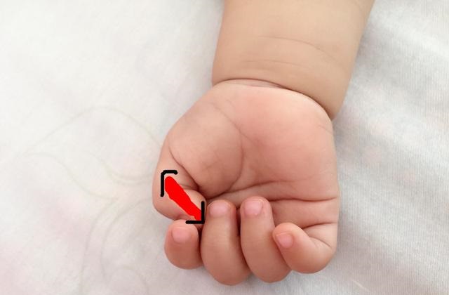 宝宝黄疸高怎么可以让黄疸退下来,宝宝黄疸偏高宝妈吃什么可以缓解