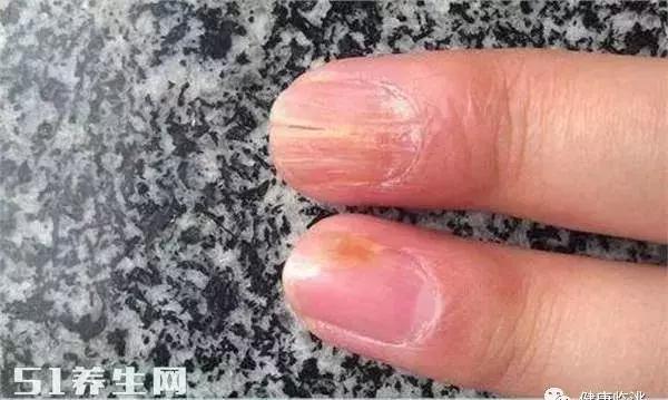手指指甲扁平凹陷是什么原因,指甲有竖纹凹陷是什么原因