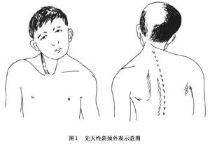 新生儿先天性肌性斜颈嘴巴是歪的,宝宝得了斜颈脖子歪怎么治