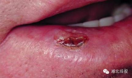 嘴唇长小肿块一查竟是癌！这个保护措施，不只女人需要！