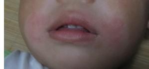 小孩子皮肤干裂怎么办,小孩冬天皮肤干裂用什么护肤品