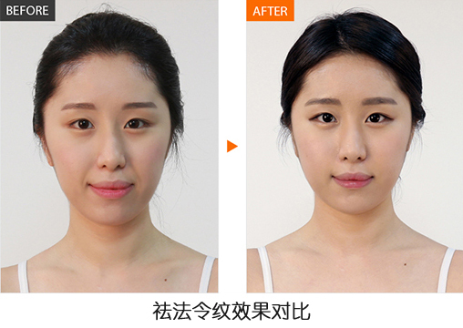 打玻尿酸的明星,为什么明星都要打玻尿酸