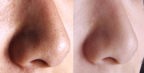 祛黑头最快最好的土方法,老中医去黑头的药膏