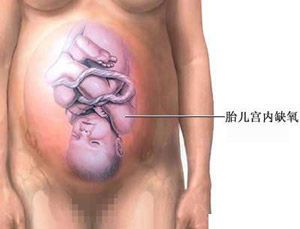 剖腹产全过程,剖腹产20天伤口真实照片