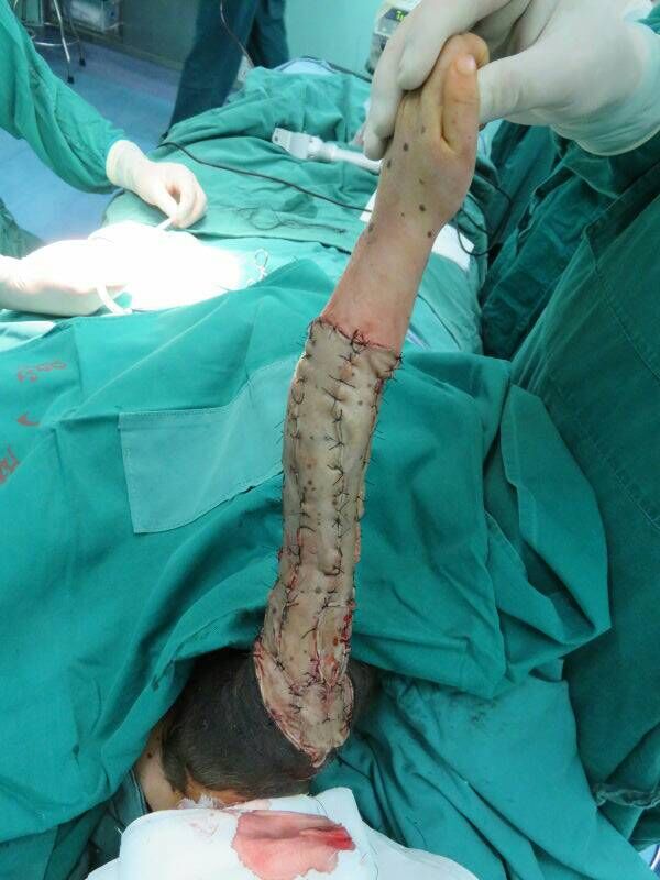 兽皮痣和巨大性黑痣图片,巨大兽皮痣癌变风险