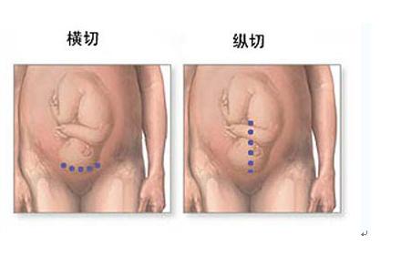 经历了剖腹产才知道妈妈的不容易,看了剖腹产才明白妈妈是多么伟大