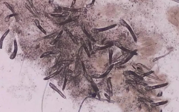 酒渣鼻严重怎么彻底治疗,酒渣鼻难道真的看不好吗