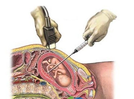 绒毛穿刺会对胎儿发育造成影响吗,绒毛穿刺致胎儿畸形吗
