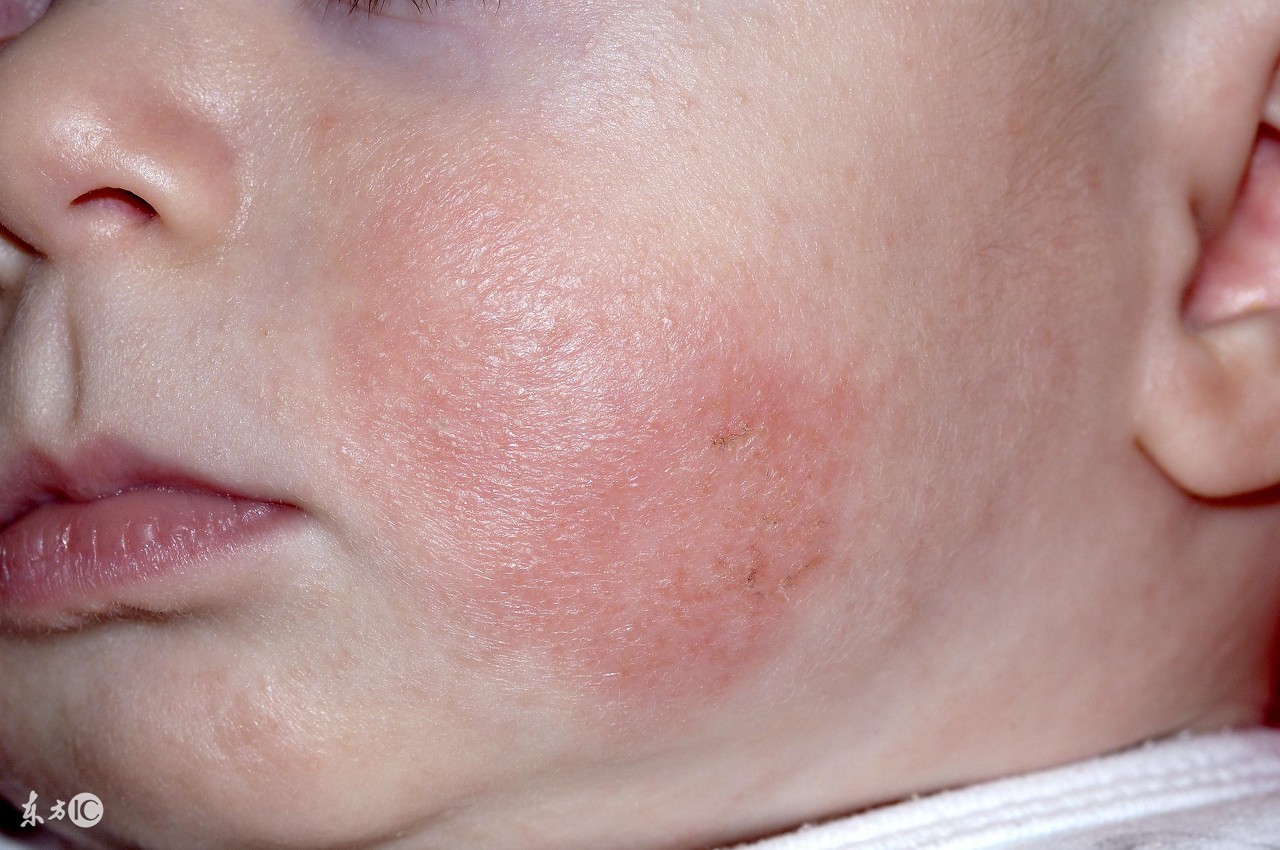 五个月宝宝湿疹反反复复推荐一下,宝宝被湿疹折磨的好痛苦