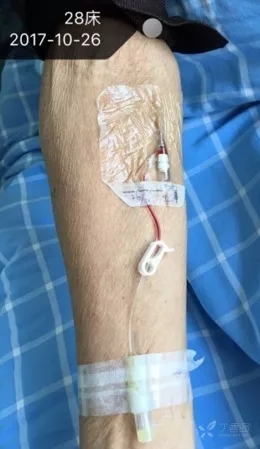 拔套管针后注意事项,套管针正常几天换一次