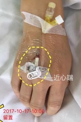 套管针的使用方法和保留方法,怎么让套管针回血
