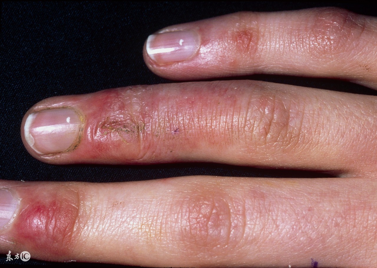 有效祛除冻疮的方法,17个小偏方告别冬天冻疮不再反复