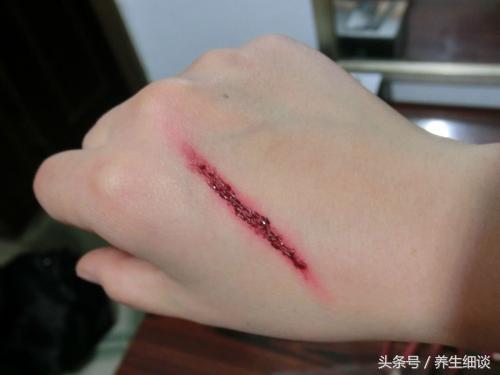 4个原因是糖尿病人伤口难愈合的罪魁祸首;6个方法,促进伤口恢复