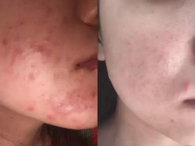 敏感肌卸妆洁面乳,适合敏感肌用的去角质洁面乳