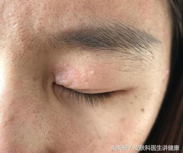 胳膊上长了皮疹是不是神经性皮炎,眼睛周围过敏性皮疹