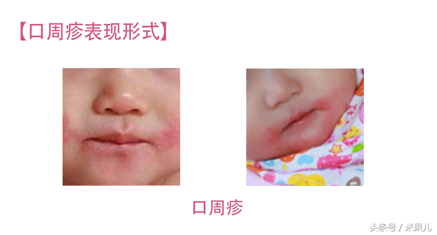 宝宝过敏怎么办新手爸妈秘籍,妈妈过敏体质宝宝怎么办