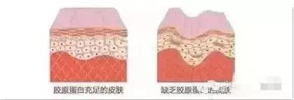 做完线雕真的会年轻吗,经常做线雕面部会年轻吗