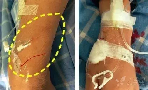 留置针断裂如何发现,留置针断裂入血管的处理方法