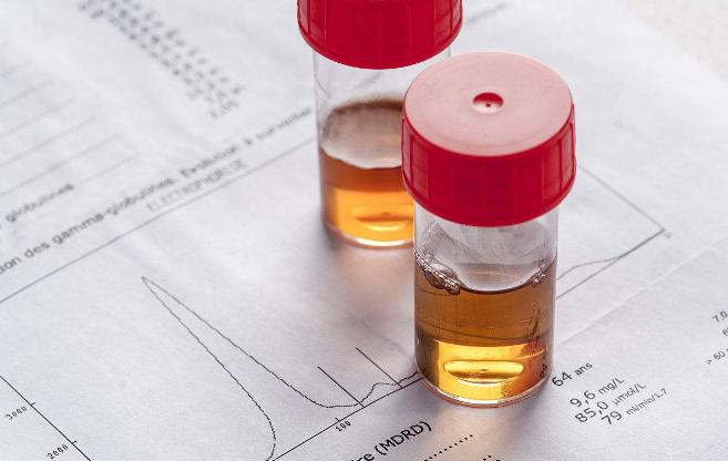 尿潜血1+阴性是怎么回事严重吗,尿潜血1+镜下红细胞1是什么意思