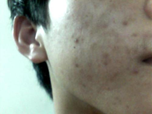 痘印痘坑修复药膏推荐第一名,对痘印有效的护肤品