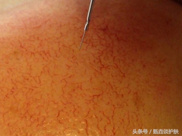 怎么修复红血丝敏感肌肤,修复敏感红血丝的方法