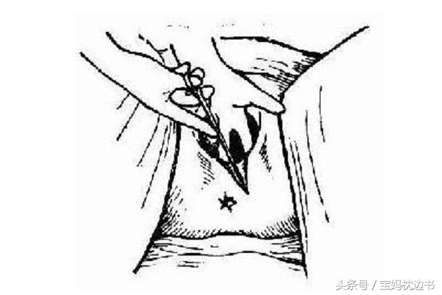 顺产是选择拆线还是不拆线好,顺产要不要选择ldr