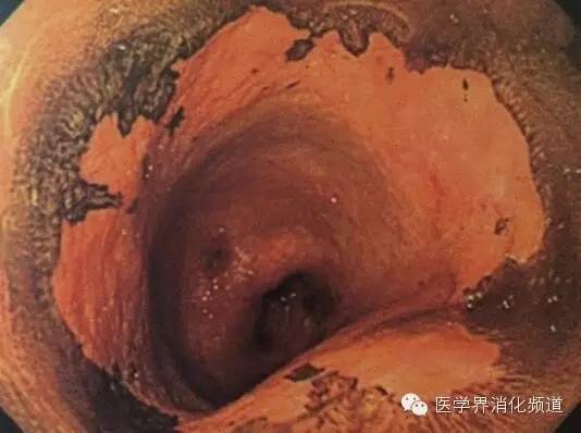 barrett食管的症状是什么,barrett食管是什么意思