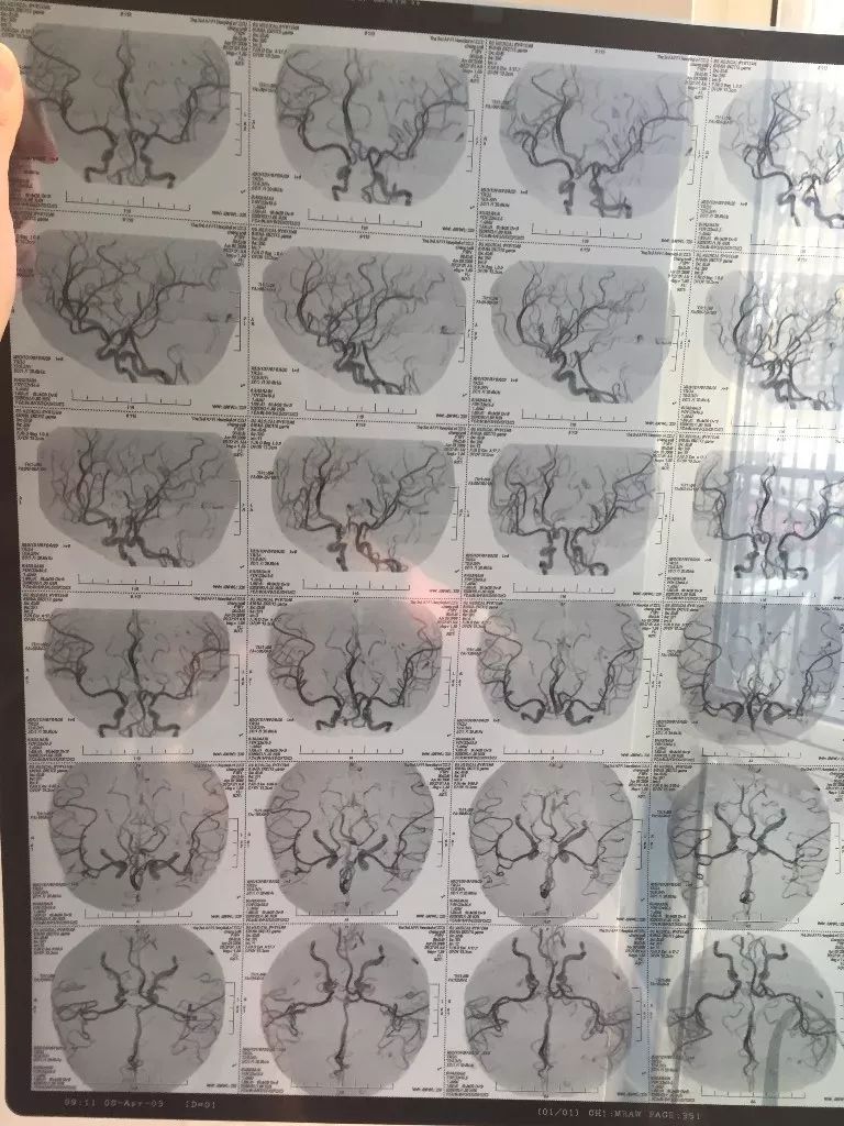 脑动静脉畸形手术费,脑动静脉畸形怎么治