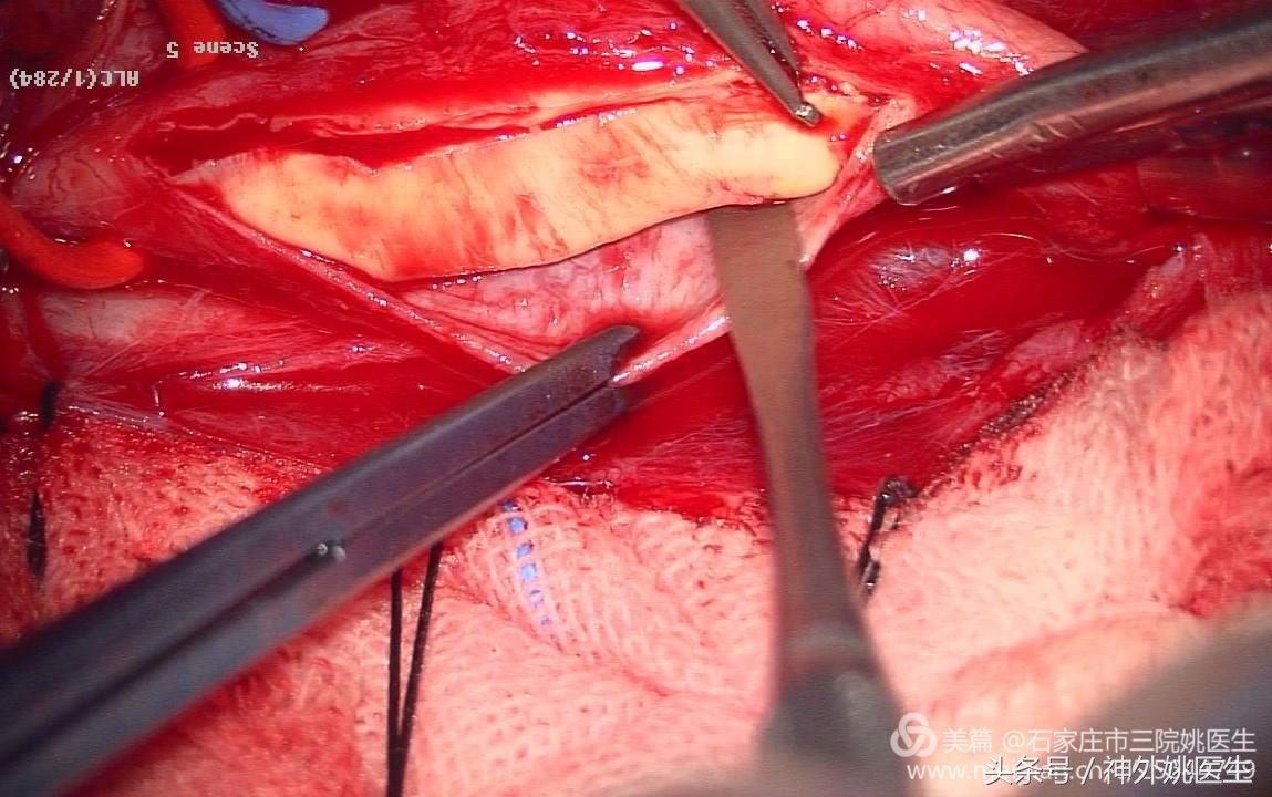 颈内动脉狭窄可以做内膜剥脱术吗,颈内动脉内膜剥脱手术指征