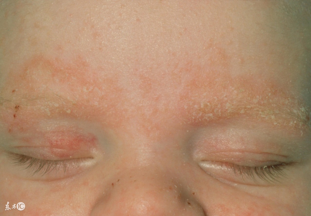 宝宝干性湿疹怎么止痒最有效,婴儿湿疹用药也不好怎么办