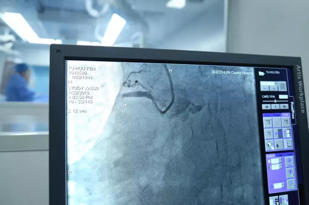 莒南县中医医院治疗冠心病,横州人民医院介入治疗冠心病