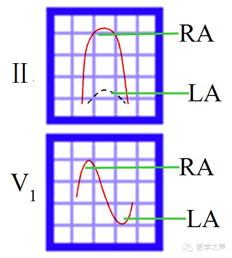 左心房肥大和右心房肥大心电图,心电图左室肥大右室肥大