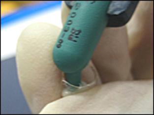 乳前牙预成冠补牙过程,乳前牙龋坏修复