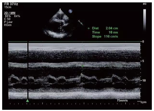 心脏扩大有什么症状和后果,心脏扩大症
