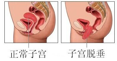 子宫脱垂：女性的“难言之隐”