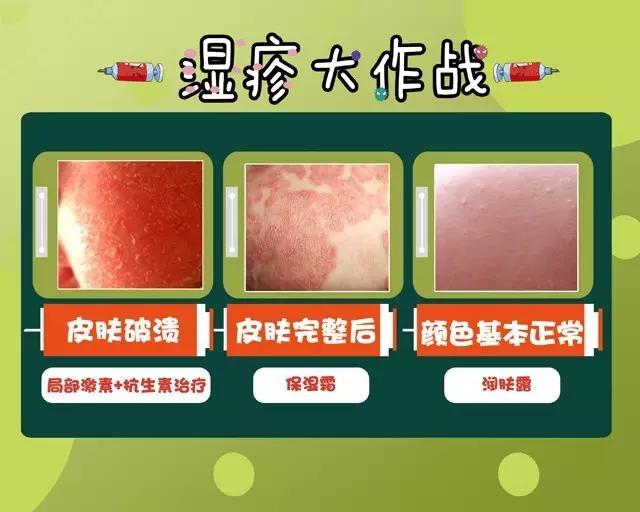 崔玉涛医生谈湿疹,婴儿湿疹和热疹的区别崔玉涛