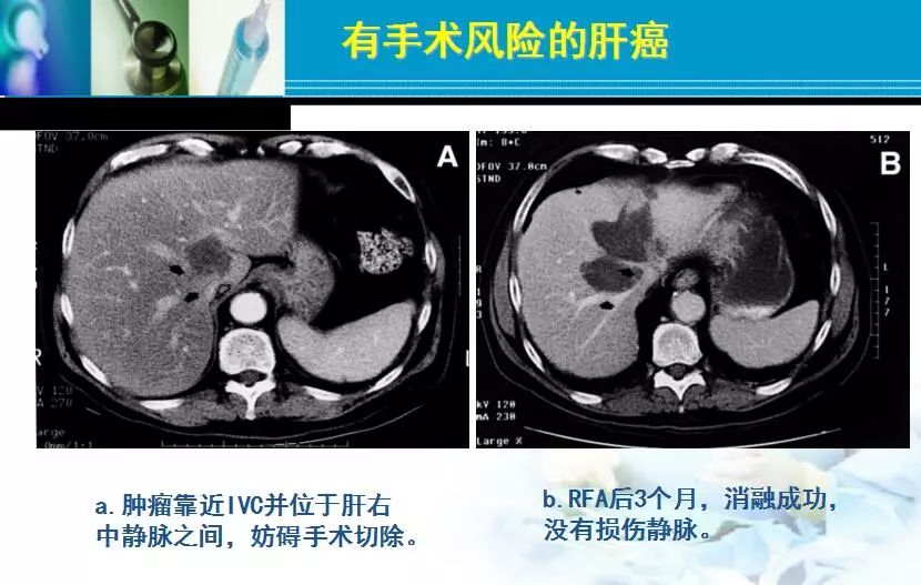 胆管肿瘤射频消融术,肿瘤射频消融厂家