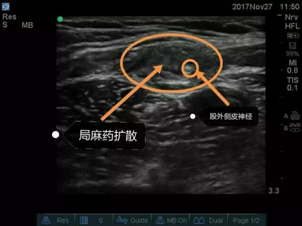超声引导隐神经阻滞视频教学,超声引导下腰椎旁神经阻滞视频