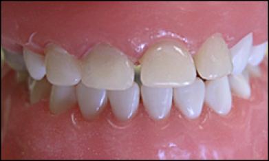 乳前牙预成冠补牙过程,乳前牙龋坏修复