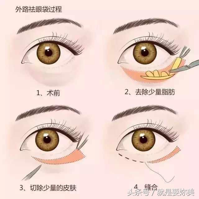 为什么坚持用护肤品却没效果,用眼霜去眼袋越来越大的原因