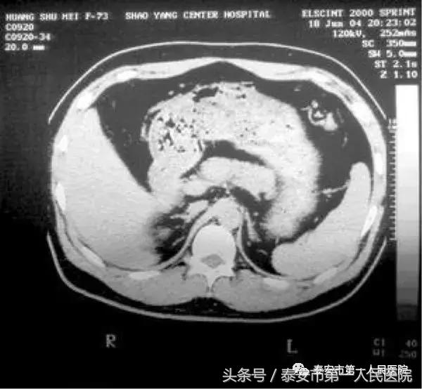 全国治疗重症胰腺炎最权威的医院,重症胰腺炎手术后多长时间能出院