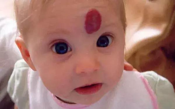 株洲1岁宝宝手臂上长了个“草莓”，急坏家长！