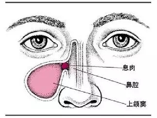 鼻窦炎已经很大了怎么办,鼻窦炎到底要怎么规避