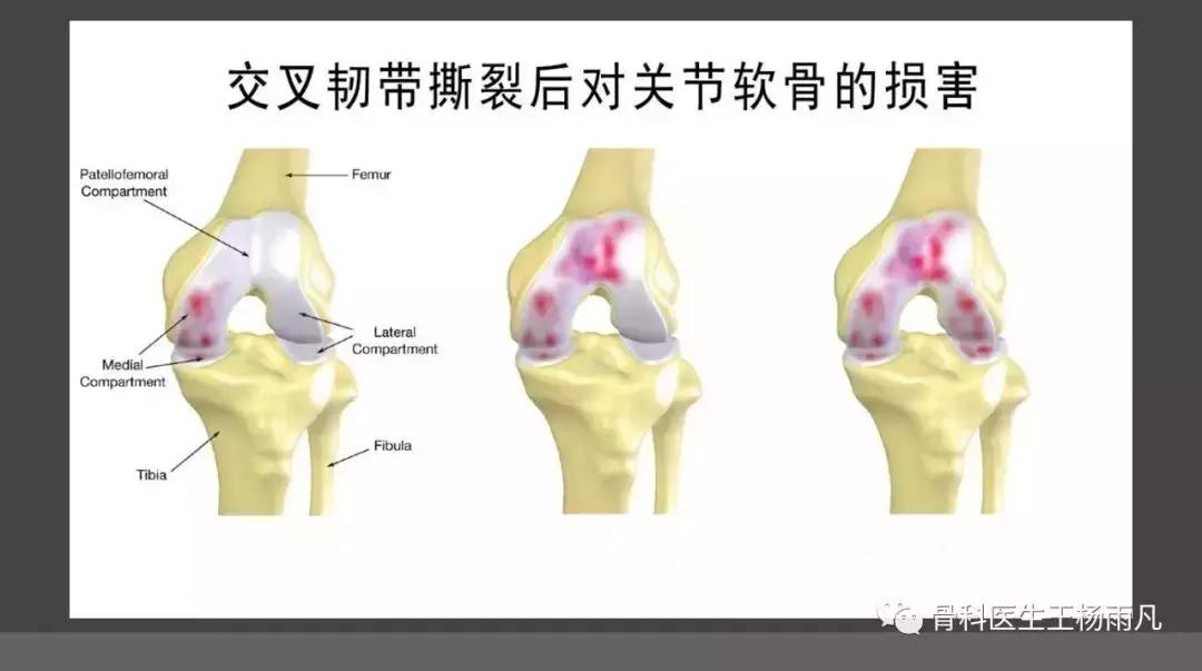 前叉重建人工韧带容易断裂吗,前叉十字韧带断裂怎么康复