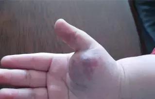 株洲1岁宝宝手臂上长了个“草莓”，急坏家长！