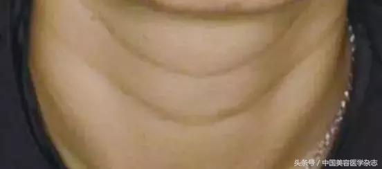 颈纹很深怎么办二十岁,玻尿酸可以祛除颈纹吗