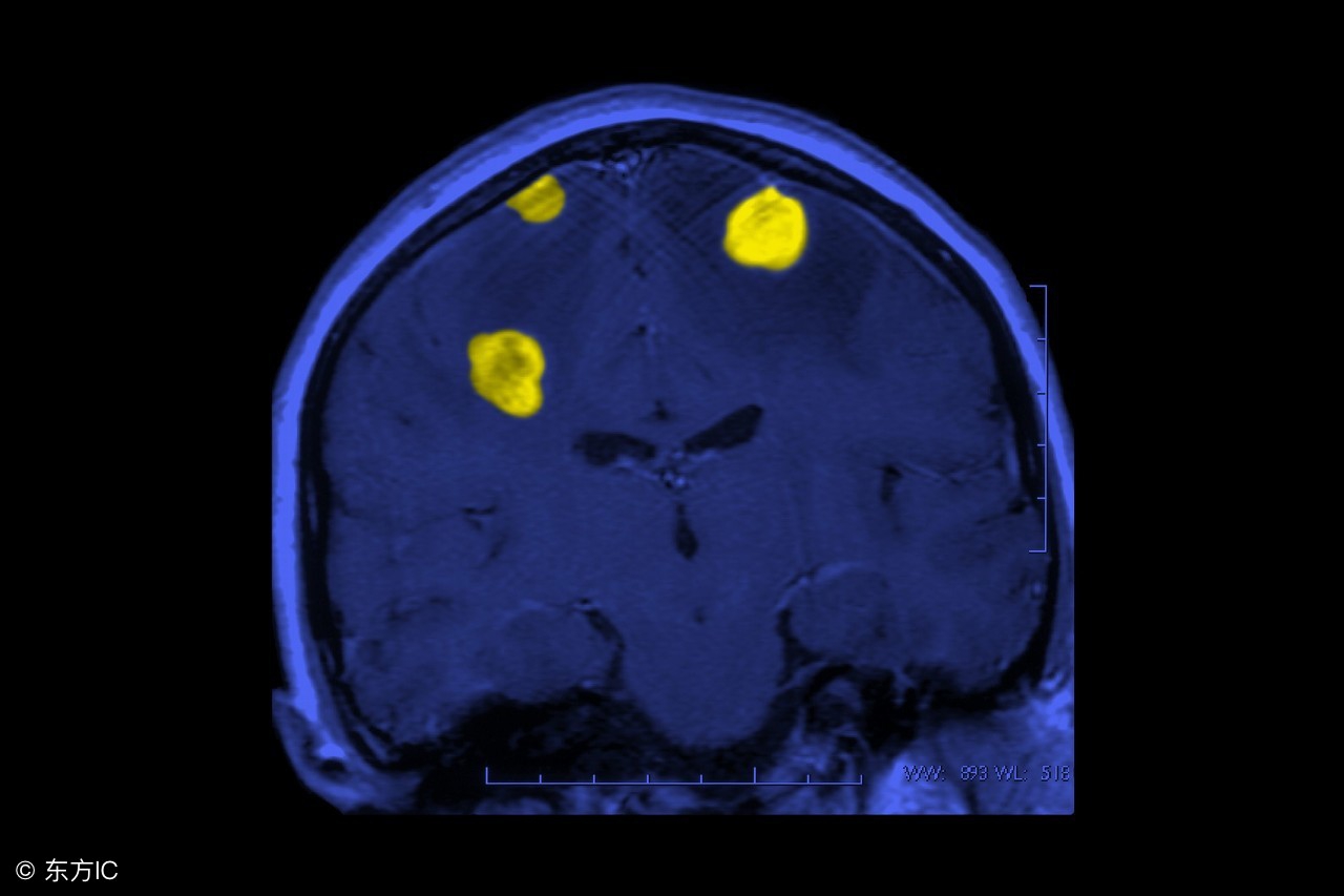 伽马刀与传统放疗相比,伽玛刀与放疗的区别是什么