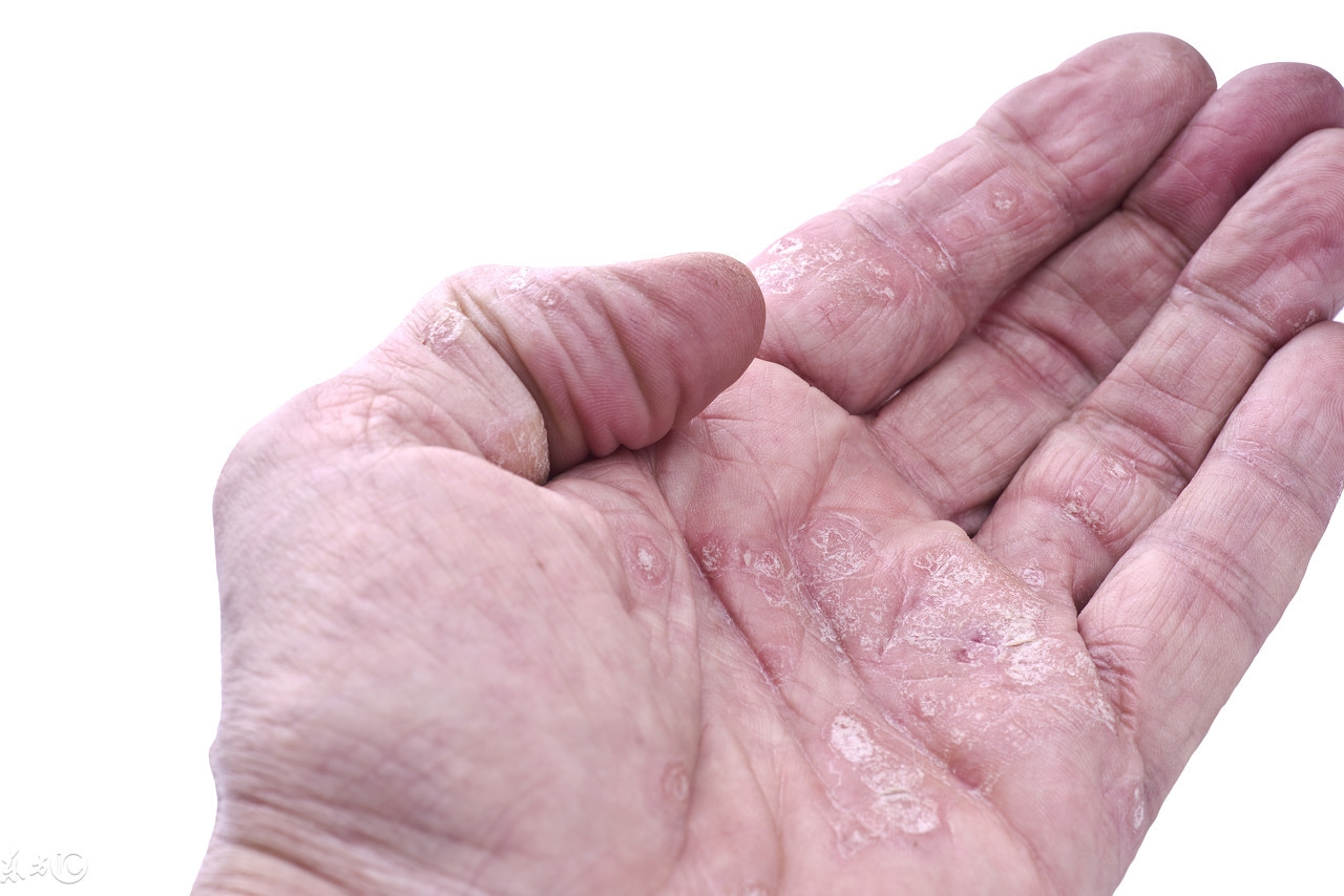 阿维a胶囊是怎么治疗银屑病的,得了银屑病吃阿莫西林管用吗