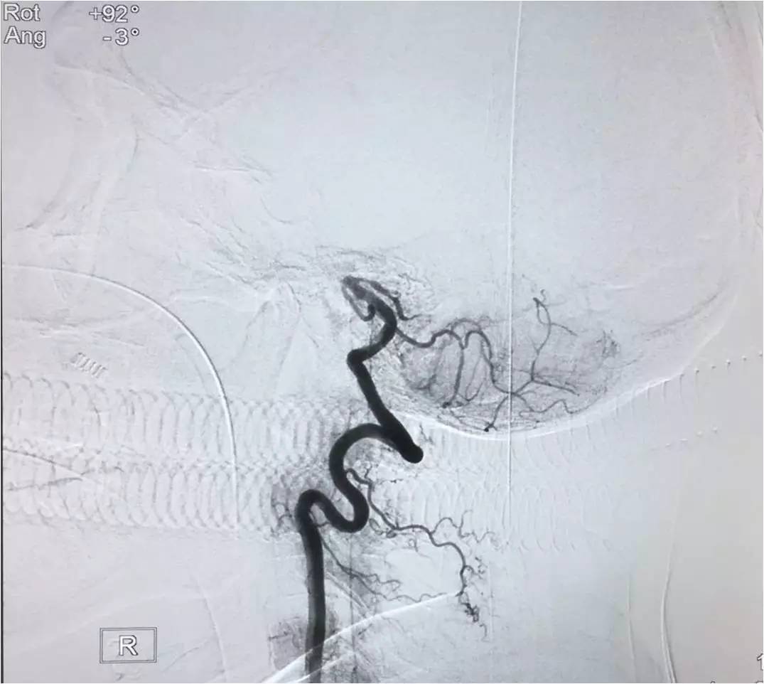 取栓慢性闭塞如何避免血栓逃逸,急性大脑中动脉栓塞取栓时间